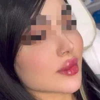 مزونیدلینگ ژل و بوتاکس|خدمات آرایشگری و زیبایی|یاسوج, |دیوار