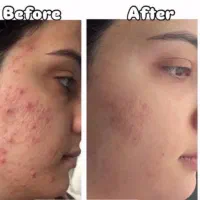 پک پوستی ضد جوش