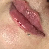 تزریق ژل و بوتاکس و مزو نیدلینگ و فیلر بادی|خدمات آرایشگری و زیبایی|امیدیه, |دیوار