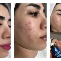 فیشال تخصصی ۳۰٪ تخفیف|خدمات زیبایی و سلامت|تهران, شهرک آزمایش|دیوار