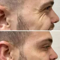 آف بوتاکس و مزوتراپی روشن کننده برای خانم و اقایون