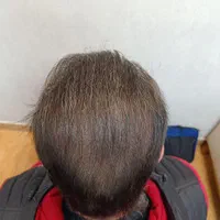 آموزش و خدمات میکرواسکالپ مکمل کاشت مو|خدمات آرایشگری و زیبایی|تهران, الهیه|دیوار