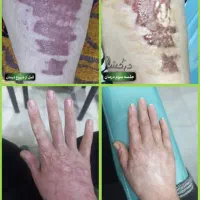 کاشت مو،ابرو و ریش