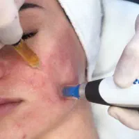 مزونیدلینگ،میکرونیدلینگ