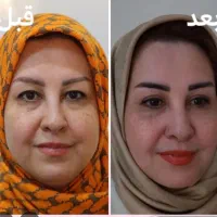 جشنواره پاییزه بلفاروپلاستی|خدمات آرایشگری و زیبایی|تهران, پاسداران|دیوار