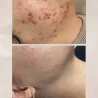 مدل پاکسازی و فشیال پوست