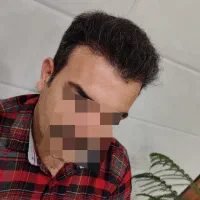 کاشت مو،ابرو،ریش
