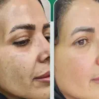 لیزر(خانم ها)۳۰۰لیزر(آقایان )۶۰۰کربن تراپی رایگان|خدمات آرایشگری و زیبایی|نجف‌آباد, باغ ملی|دیوار