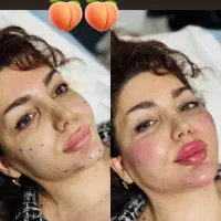 تخفیف جشنواره تزریق ژل و فیلر لب و فول فیس در مطب|خدمات آرایشگری و زیبایی|اصفهان, چرخاب|دیوار