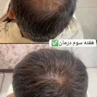 ریزش موهاتو به من بسپر