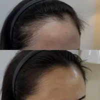 پذیرش مدل میکرو اسکالپ سر بانوان، انجام تخصصی