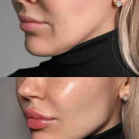 مطب زیبایی تپش .جشنواره تخفیف/لیزر/ژل بوتاکس|خدمات آرایشگری و زیبایی|گلبهار, شهر جدید گلبهار|دیوار