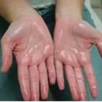 مقابله با تعریق شدید بدن هایپرهیدروزیس