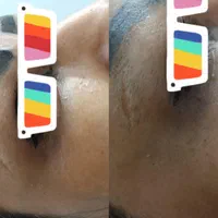 رفع غبغب رفع تیرگی رفع خطوط عمیق لبخند و دور چشم|خدمات آرایشگری و زیبایی|مشهد, هنرستان|دیوار