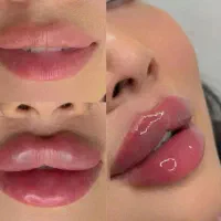 جشنواره ژل بوتاکس فیلر لیزرجوانسازمزو|خدمات آرایشگری و زیبایی|تبریز, |دیوار