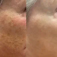پاکسازی سوپرفشیال تخصصی، مطب ویژه آقایان وبانوان|خدمات زیبایی و سلامت|تهران, نارمک|دیوار