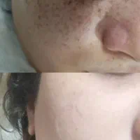 ازبین بردن کک ومک در یک جلسه تضمینی نقاهت ۴تا۷ روز