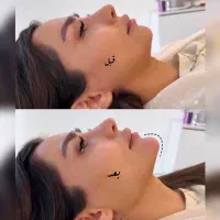 ژل لب روسی زاویه فک گونه چونه فیلرزیرچشم شقیقه نخ|خدمات آرایشگری و زیبایی|تهران, پاسداران|دیوار