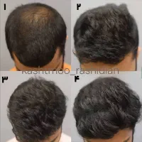 پی آر پی و مزوتراپی prp مو و ابرو|خدمات آرایشگری و زیبایی|اردبیل, |دیوار