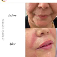 بوتاکس فیلر پی ار پی