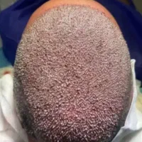 کاشت مو با بالا ترین تراکم و نازلترین قیمت|خدمات آرایشگری و زیبایی|تبریز, |دیوار