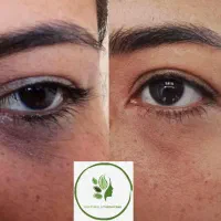 فیشال حرفه ای ۳۵۰ محدود،پاکسازی پوست ودرمان تخصصی|خدمات آرایشگری و زیبایی|صدرا-فارس, فاز ۱|دیوار