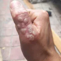 درمان زیگیل و تبخال