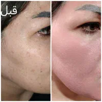 پاکسازی و جوانسازی پوست با آکوا فیشیال|خدمات آرایشگری و زیبایی|اردبیل, |دیوار