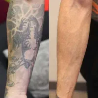 پاک کردن تتو.لیزرکیوسوییچ.PRP.کربن تراپی.روشن سازی|خدمات آرایشگری و زیبایی|اصفهان, سعادتآباد|دیوار