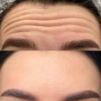 جشنواره تزریق بوتاکس مصپورت فقط ۷۹۰ تومان