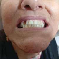 دندانسازی متحرک تکی و کامل