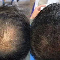 رفع کم پشتی موی سر ریش و ابرو،رفع تیرگی دائمی لب