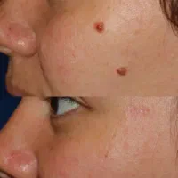 خال برداری رفع کک و مک با لیزر