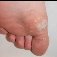 فریز زگیل ( بالوکە )|خدمات آرایشگری و زیبایی|بوکان, |دیوار