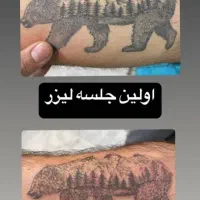 بلفاروپلاستی، پاک کردن تتو در جنوب تهران|خدمات آرایشگری و زیبایی|باقرشهر, |دیوار