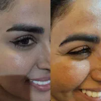 تزریق ژل و بوتاکس مزو تراپی جوانسازی تخلیه میلیا|خدمات آرایشگری و زیبایی|مشهد, ثامن|دیوار