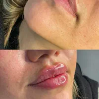 تخفیفات 50% ژل و بوتاکس شروع قیمت از ۳۰۰ت|خدمات آرایشگری و زیبایی|قم, سالاریه|دیوار