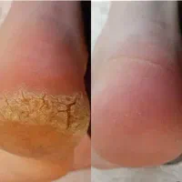 تخفیف پدیکور درمانی