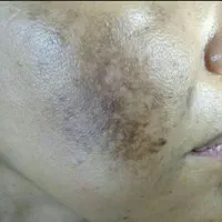 فیشال تخصصی و درمان لک