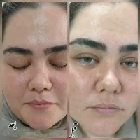 حذف کک ومک تک جلسه ای،حذف موهای زائد