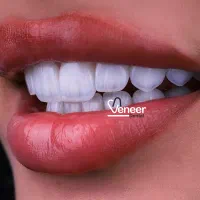 دندانپزشکی لمینت الهیه منطقه ۱ کامپوزیت سرامیکی|خدمات آرایشگری و زیبایی|تهران, الهیه|دیوار