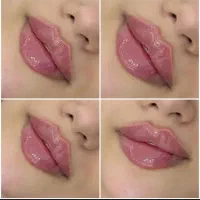 فیلر، ژل و بوتاکس