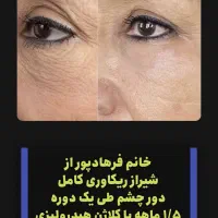 کرم بوتاکس صورت|آرایشی، بهداشتی، درمانی|اهواز, کیان اباد|دیوار