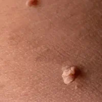 زگیل خال گوشتی اسکن تگ