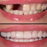 مرکز تخصصی دندانپزشکی ایمپلنت شرایط ویژه اقساطی