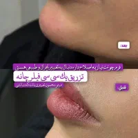 لیزر موهای زائد با دستگاه الکس و تیتانیوم|خدمات آرایشگری و زیبایی|قم, صفائیه|دیوار
