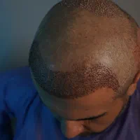 کاشت تخصصی مو به روش FIT