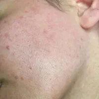 الکترولیز تنها روش قطعی از بین بردن هر نوع مو|خدمات آرایشگری و زیبایی|صدرا-فارس, فاز ۱|دیوار