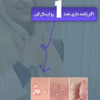 رفع زگیل و تبخال