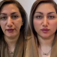 تزریق ژل وفیلرو انزیم و ساکشن فیلربادی|خدمات آرایشگری و زیبایی|کرمانشاه, |دیوار